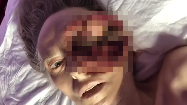 【閲覧注意】左眼が腐ってウジが湧いてしまった女性のグロ動画。