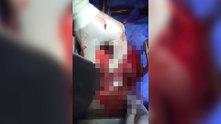 【閲覧注意】心臓に撃ち込まれた弾丸を摘出するグロ動画。