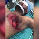 【閲覧注意】左胸から肺が飛び出してしまった男性の手術映像。