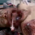 【閲覧注意】バイク事故で顎が砕けてしまった男性の手術映像。