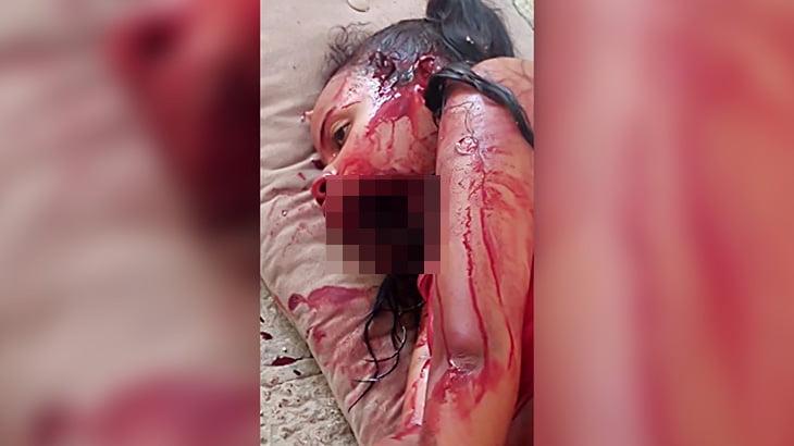 【閲覧注意】家族を銃で殺され、自身も顎を粉砕されてしまった女の子のグロ動画。