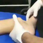 足首の脱臼を元に戻す施術映像。