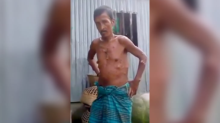 お尻に巨大な腫瘍を持つ男の映像。