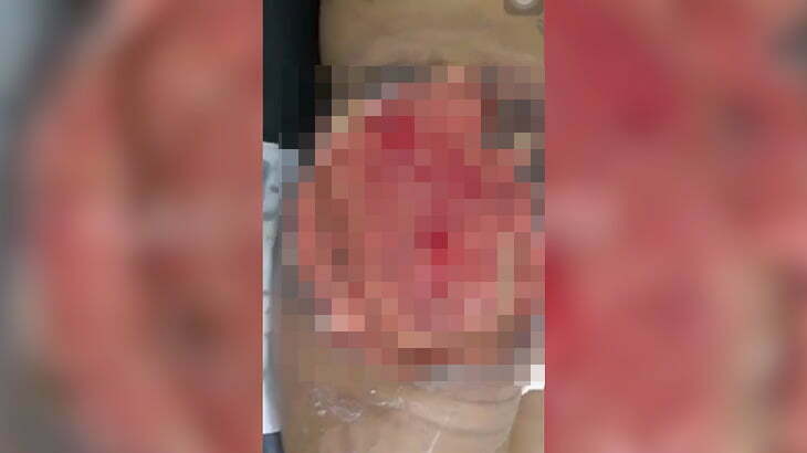 【閲覧注意】注入したシリコンのせいでお尻が壊死してしまった女性の映像。