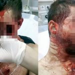 【閲覧注意】シートベルトをせずに事故った男性の顔がヤバいことになってしまったグロ画像。