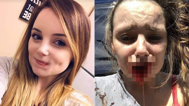 【閲覧注意】元カレに下唇を噛みちぎられてしまった女性の画像。