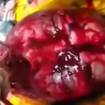 【閲覧注意】バーで喧嘩になり口を破壊されてしまった男性の手術映像。