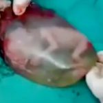 【閲覧注意】羊膜嚢に入ったまま堕胎された新生児の映像。