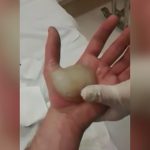 手のひらにできた大きな水ぶくれを潰して皮膚を切り取る映像。
