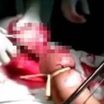 【閲覧注意】ノコギリで左腕を切断する手術映像。