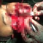 【閲覧注意】腫瘍摘出のために顔をパカッと切り開かれた男のグロ動画。
