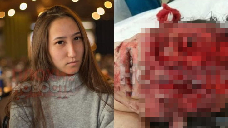 【閲覧注意】犬に食われてとんでもない顔になってしまった女性のグロ画像。