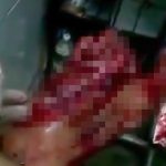 【閲覧注意】バイク事故で左足の甲を破壊されてしまったグロ動画。