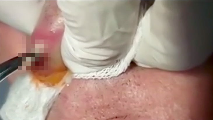 唇に埋まったボットフライを摘出する映像。