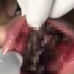 【閲覧注意】歯茎に大量のウジ虫が蠢くグロ動画。