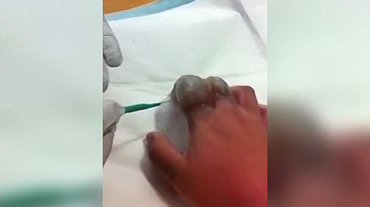 指にできた大きな水ぶくれを切除する手術映像。