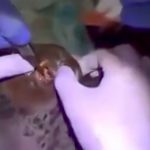 【閲覧注意】男性の耳の中からウジ虫を摘出する手術映像。