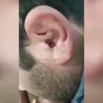 男性の耳の穴からムカデが這い出てくる映像。