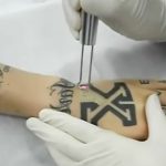 レーザーで手の甲のタトゥーをあっという間に除去する映像。