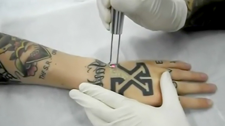 レーザーで手の甲のタトゥーをあっという間に除去する映像。