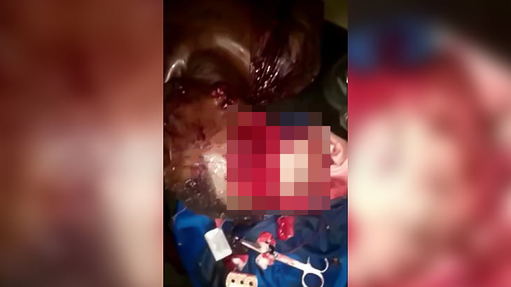 【閲覧注意】マチェーテで頭蓋骨をスライスされてしまった男性の映像。