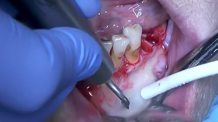 【閲覧注意】歯茎に出来た膿を摘出する手術映像。