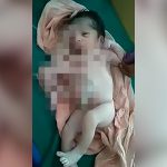 【閲覧注意】4本の腕と4本の脚を持って生まれてきてしまった新生児の映像。