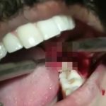 【閲覧注意】親知らずを抜歯する手術映像。