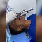 男の喉に詰まってしまった魚を引っこ抜く手術（動画）