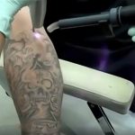 腕のタトゥーをレーザーであっという間に消していく手術映像。