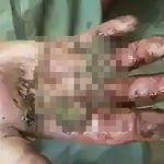 【閲覧注意】右手をウジ虫に食われまくってる男のグロ動画。