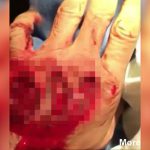 【閲覧注意】事故で手の甲の皮膚が剥がれて腱が丸見えになってしまったグロ動画。