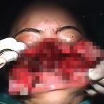 【閲覧注意】顔をパカッと切り開いて何かを切除して元に戻す手術映像。