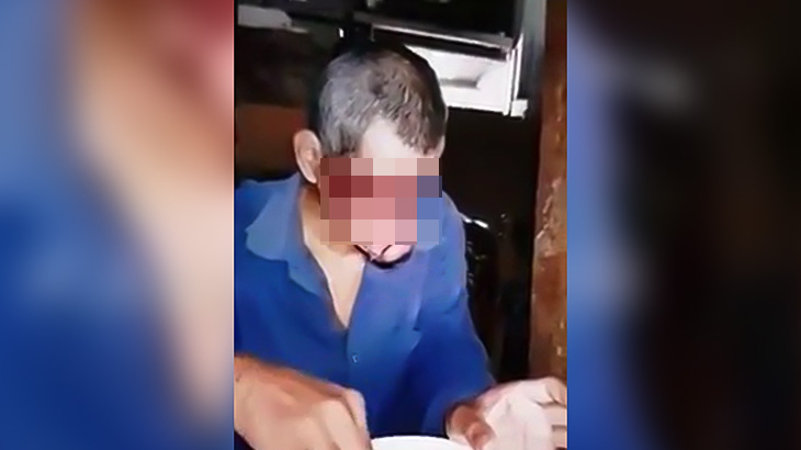 【閲覧注意】目と鼻が無く下顎しかない男が食事をする映像。