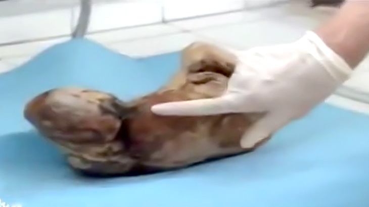 46年間も母親の体内に居続けて石灰化した胎児の映像。