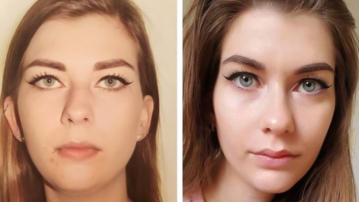 整形して理想の顔を手に入れた人たちの画像集20枚