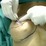 【微閲覧注意】お尻の脂肪を吸い取ってオッパイに注入する手術映像