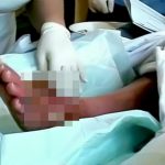 【微閲覧注意】足の甲に出来た大きな水ぶくれを針で刺して膿を出す映像