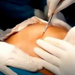 【閲覧注意】85歳の女性のお腹からラグビーボールくらいの腫瘍を摘出する手術映像