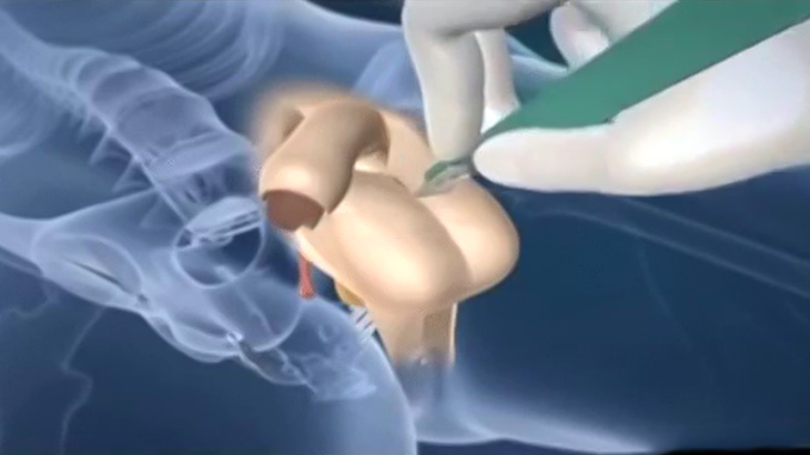 【閲覧注意】男性器から女性器を作り出す解説映像と実際の手術映像。