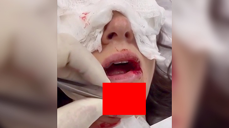 【動画】夫にDVされて顎から下の歯が丸見えになってしまった女性