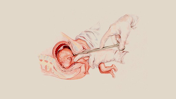 【超！閲覧注意】中絶で身体をバラバラにされる胎児たち、こんなの気が狂うだろ･･･（動画）