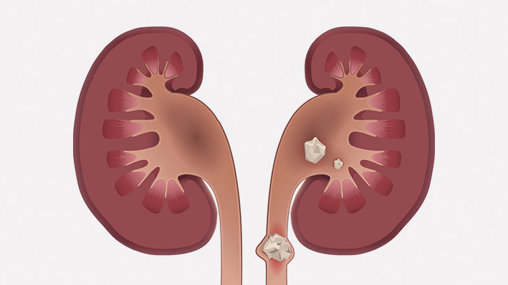 【閲覧注意】男性の腎臓から摘出された尿結石、デカすぎる･･･（動画）