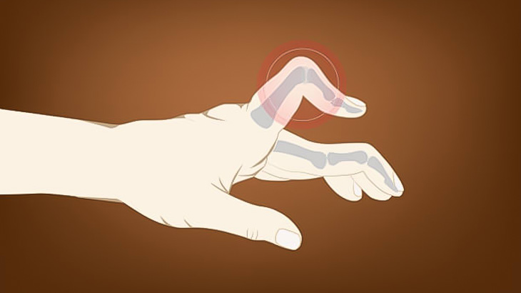 金を返せなかった男、手の指を折られてしまう･･･（動画）