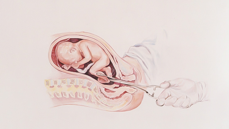 【閲覧注意】「後期中絶」の映像、エグすぎる･･･（動画）