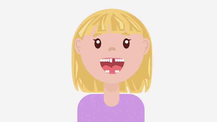 歯が無い女性がインプラントした結果 → 10歳くらい若返る（動画）