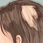 【閲覧注意】「髪の毛を食べてしまう病気」の人の頭はこんな感じ（動画）