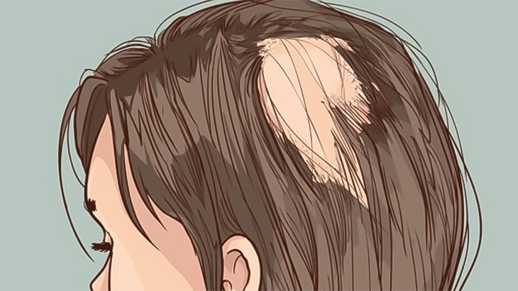 【閲覧注意】「髪の毛を食べてしまう病気」の人の頭はこんな感じ（動画）