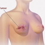 【閲覧注意】末期乳がんの女性たち、ヤバすぎる･･･（画像）
