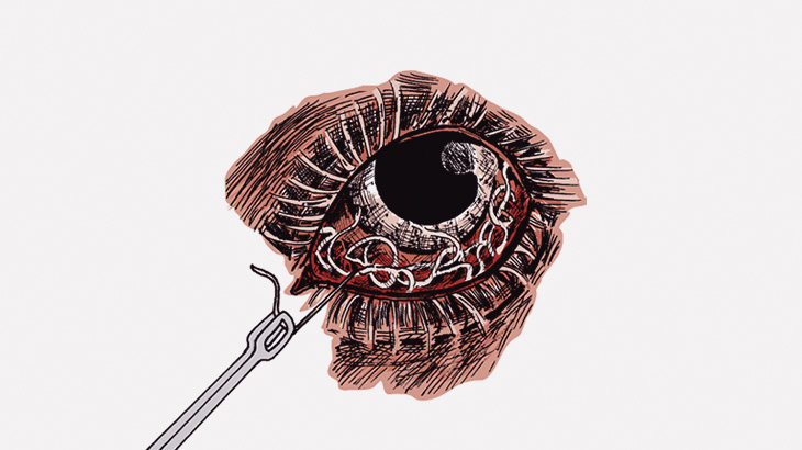 【閲覧注意】医者「まぶたに寄生虫いるんで取りますねー」（動画）